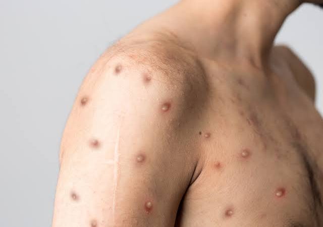 Ministro diz que Brasil terá antiviral para tratar varíola dos macacos